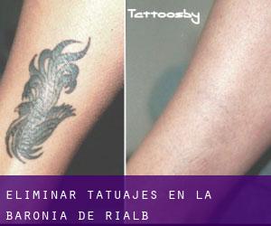 Eliminar tatuajes en la Baronia de Rialb