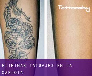 Eliminar tatuajes en La Carlota