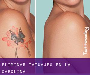 Eliminar tatuajes en La Carolina
