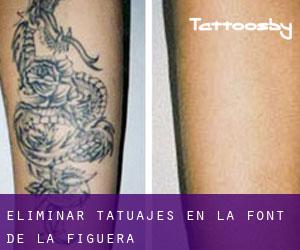 Eliminar tatuajes en La Font de la Figuera