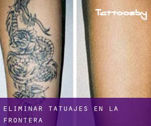 Eliminar tatuajes en La Frontera