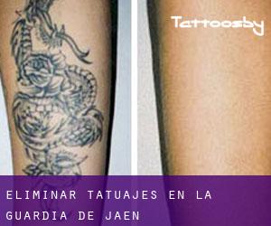 Eliminar tatuajes en La Guardia de Jaén