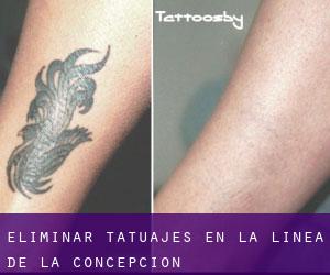 Eliminar tatuajes en La Línea de la Concepción