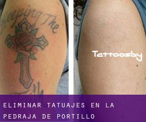 Eliminar tatuajes en La Pedraja de Portillo
