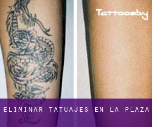 Eliminar tatuajes en La Plaza