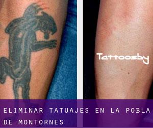 Eliminar tatuajes en la Pobla de Montornès