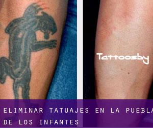 Eliminar tatuajes en La Puebla de los Infantes