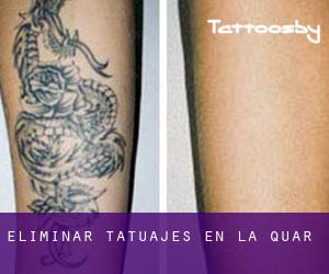 Eliminar tatuajes en la Quar