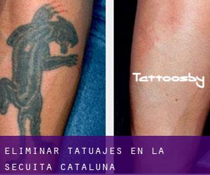 Eliminar tatuajes en la Secuita (Cataluña)