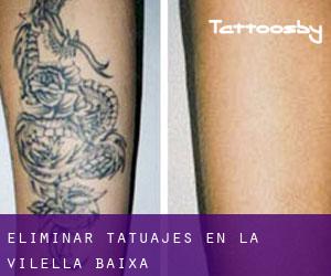 Eliminar tatuajes en la Vilella Baixa