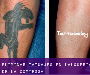 Eliminar tatuajes en L'Alqueria de la Comtessa