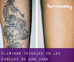 Eliminar tatuajes en Las Cabezas de San Juan