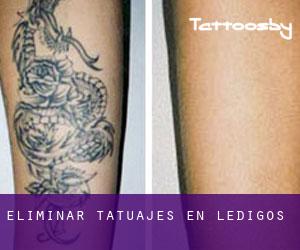 Eliminar tatuajes en Ledigos