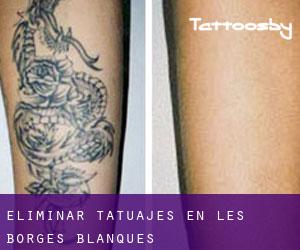 Eliminar tatuajes en les Borges Blanques