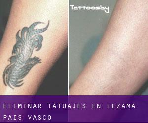 Eliminar tatuajes en Lezama (País Vasco)