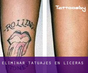Eliminar tatuajes en Liceras