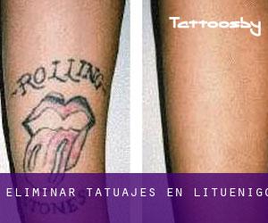 Eliminar tatuajes en Lituénigo