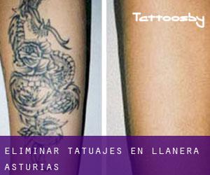 Eliminar tatuajes en Llanera (Asturias)