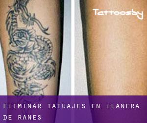 Eliminar tatuajes en Llanera de Ranes