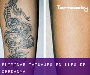 Eliminar tatuajes en Lles de Cerdanya