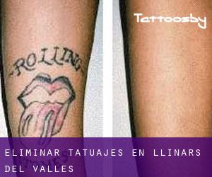 Eliminar tatuajes en Llinars del Vallès