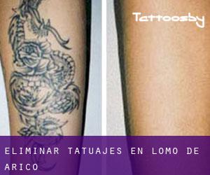 Eliminar tatuajes en Lomo de Arico