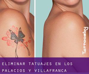 Eliminar tatuajes en Los Palacios y Villafranca