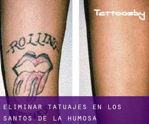 Eliminar tatuajes en Los Santos de la Humosa