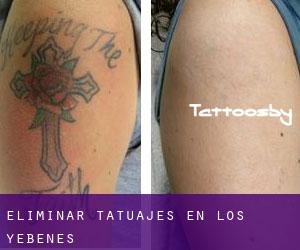 Eliminar tatuajes en Los Yébenes