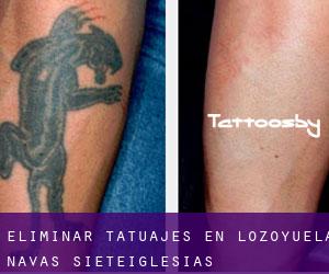 Eliminar tatuajes en Lozoyuela-Navas-Sieteiglesias