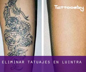 Eliminar tatuajes en Luintra