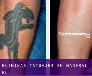 Eliminar tatuajes en Maderal (El)