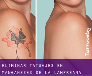 Eliminar tatuajes en Manganeses de la Lampreana