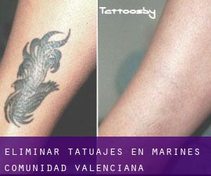 Eliminar tatuajes en Marines (Comunidad Valenciana)