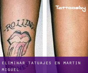 Eliminar tatuajes en Martín Miguel