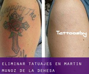 Eliminar tatuajes en Martín Muñoz de la Dehesa