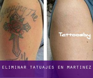 Eliminar tatuajes en Martínez