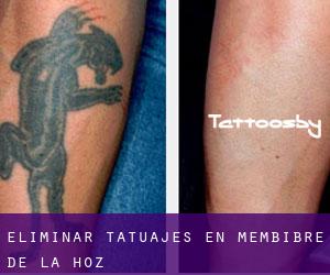 Eliminar tatuajes en Membibre de la Hoz