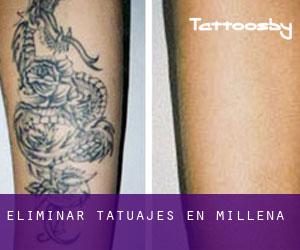 Eliminar tatuajes en Millena