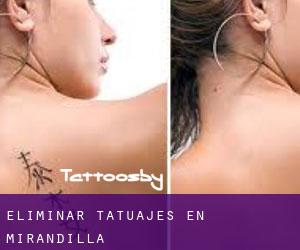 Eliminar tatuajes en Mirandilla