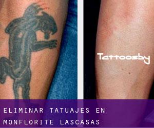 Eliminar tatuajes en Monflorite-Lascasas