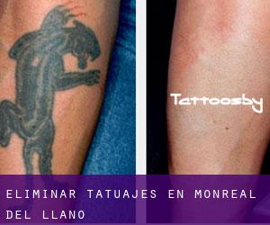Eliminar tatuajes en Monreal del Llano
