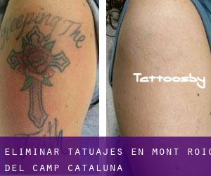 Eliminar tatuajes en Mont-roig del Camp (Cataluña)