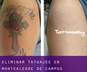 Eliminar tatuajes en Montealegre de Campos