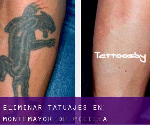 Eliminar tatuajes en Montemayor de Pililla
