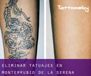 Eliminar tatuajes en Monterrubio de la Serena