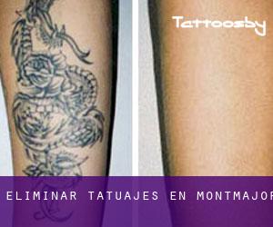 Eliminar tatuajes en Montmajor