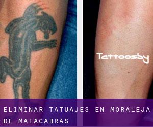 Eliminar tatuajes en Moraleja de Matacabras