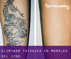 Eliminar tatuajes en Morales del Vino