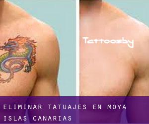 Eliminar tatuajes en Moya (Islas Canarias)